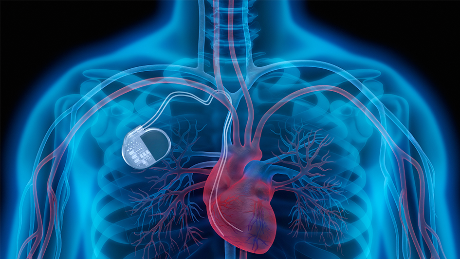 Mirmex Motor | Active Implant Mirmex Motor | Active Implant